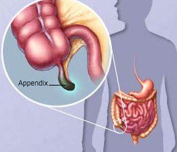 Как распознать аппендицит: симптомы и лечение